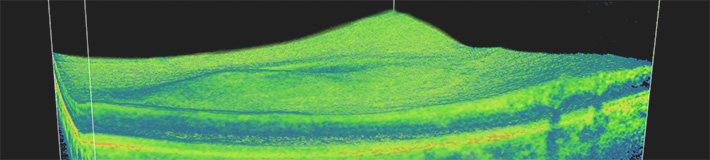 OCT（光干渉断層計）検査の画像