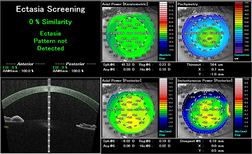 前眼部OCTによる解析画像例
