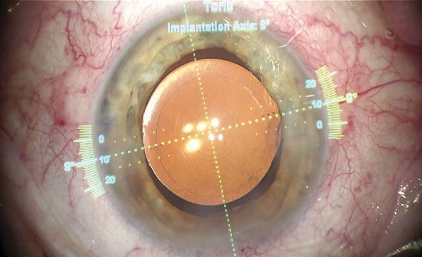 アルコン社「アルゴス・ベリオン」